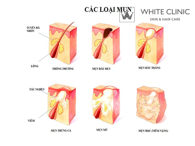 nguyên nhân gây mụn