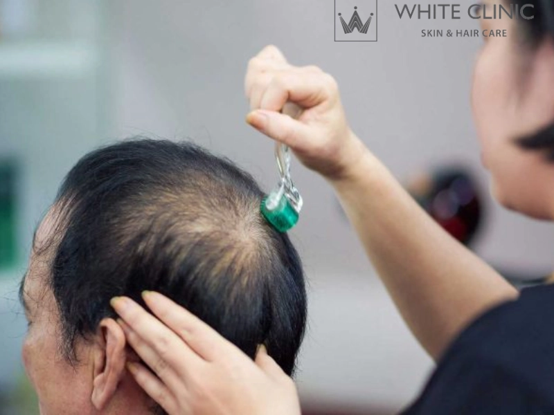 Lăn Kim Mọc Tóc Có Tốt Không? Tìm Hiểu Liệu Trình HAIRGEN Tại White Clinic