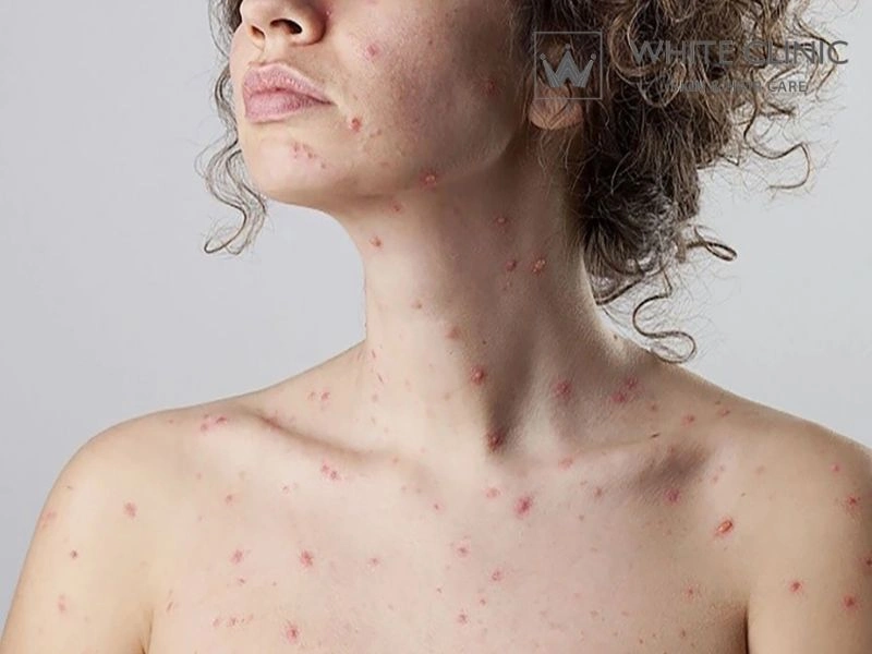 trị sẹo lõm thủy đậu trị sẹo lõm thủy đậu