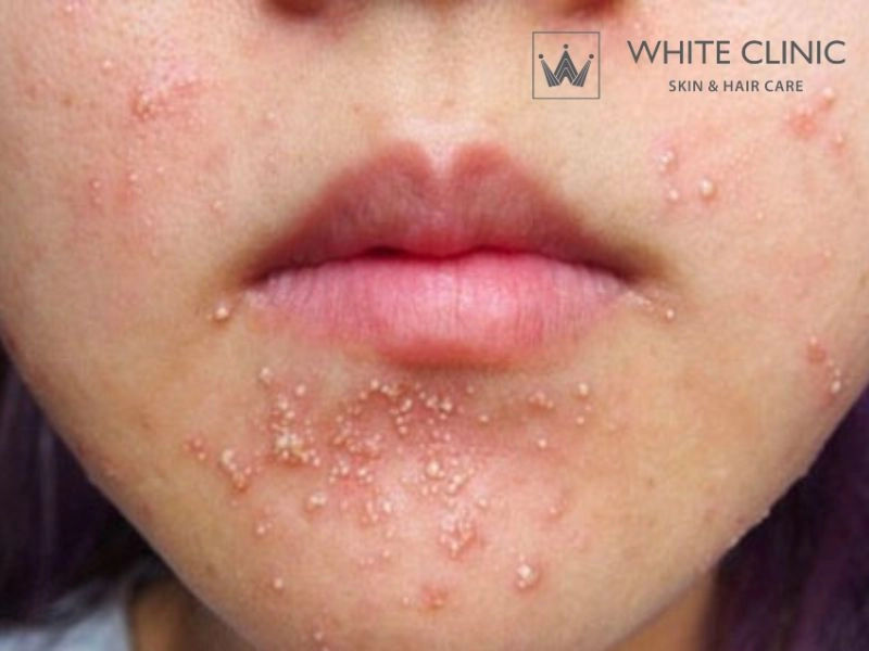 mụn đầu trắng