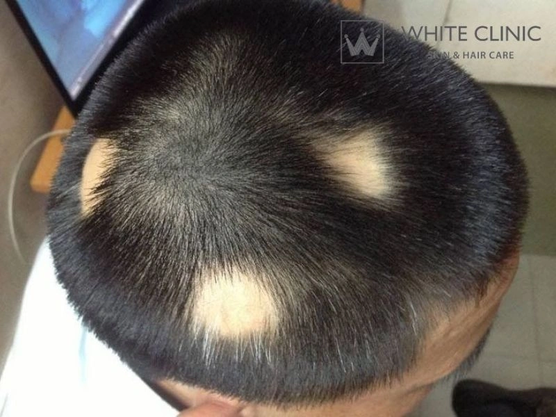 kinh nghiệm chữa rụng tóc từng mảng kinh nghiệm chữa rụng tóc từng mảng