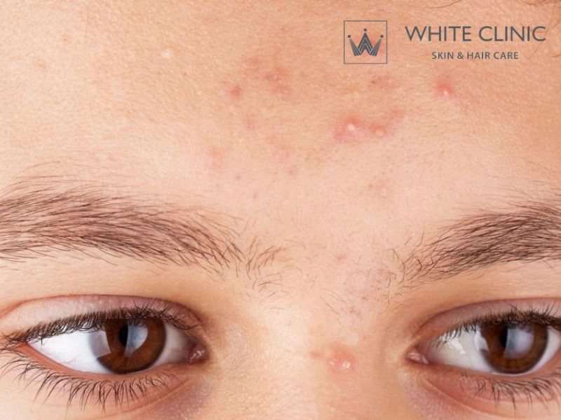 Các phương pháp điều trị mụn đầu trắng chuẩn y khoa hiện nay