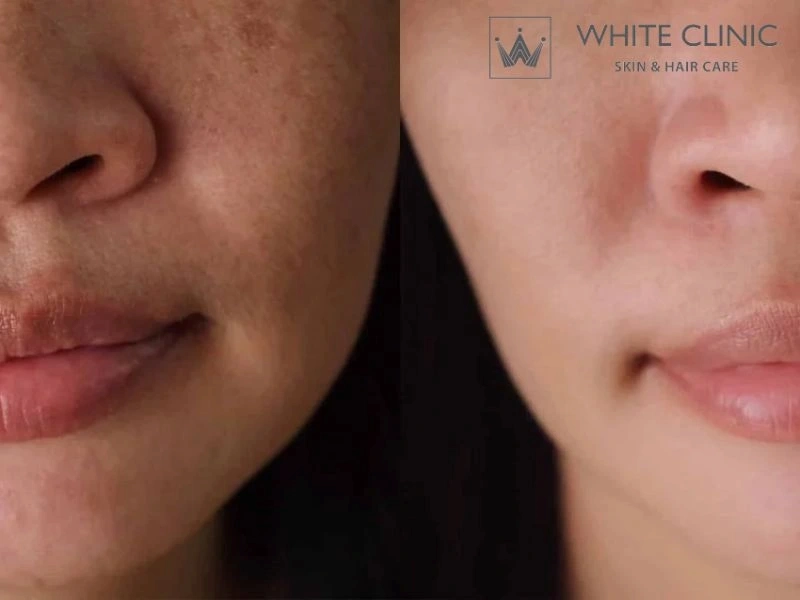 công nghệ laser co2 fractional có tốt không công nghệ laser co2 fractional có tốt không