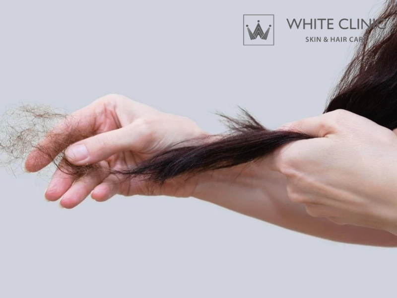 rụng tóc do tuyến giáp rụng tóc do tuyến giáp