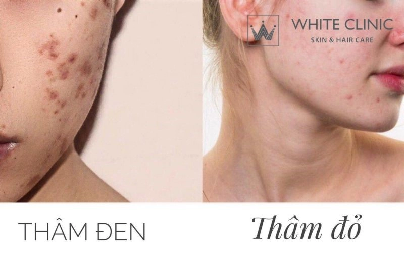 các loại sẹo mụn