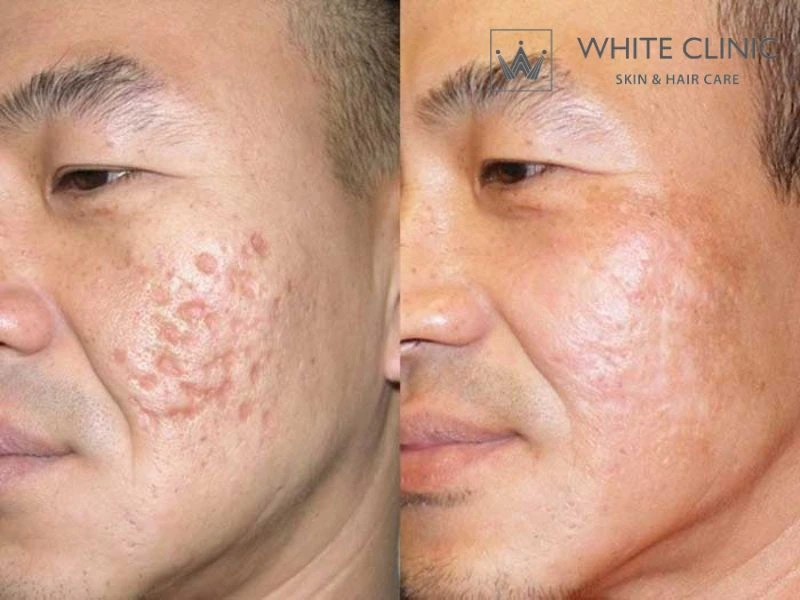 Quy trình điều trị sẹo lượn sóng chuyên sâu tại White Clinic Quy trình điều trị sẹo lượn sóng chuyên sâu tại White Clinic
