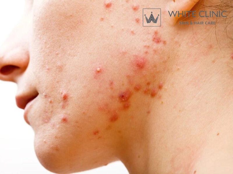 10+ Nguyên Nhân Gây Mụn Trên Da Mà Bạn Nên Biết Và Phương Pháp Điều Trị Hiệu QUả 