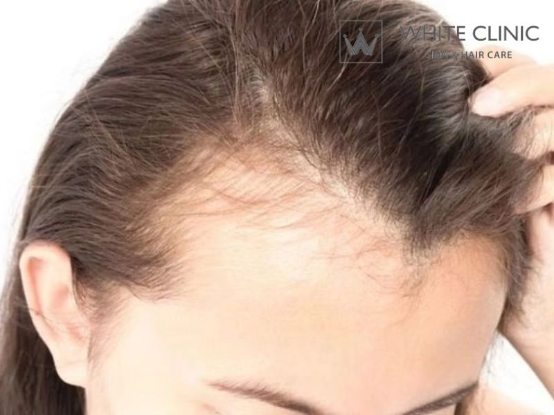 hói chữ m hói chữ m