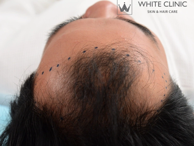 da đầu yếu da đầu yếu