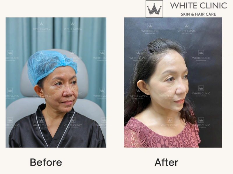 Bio Lift 20 Bio Lift 20