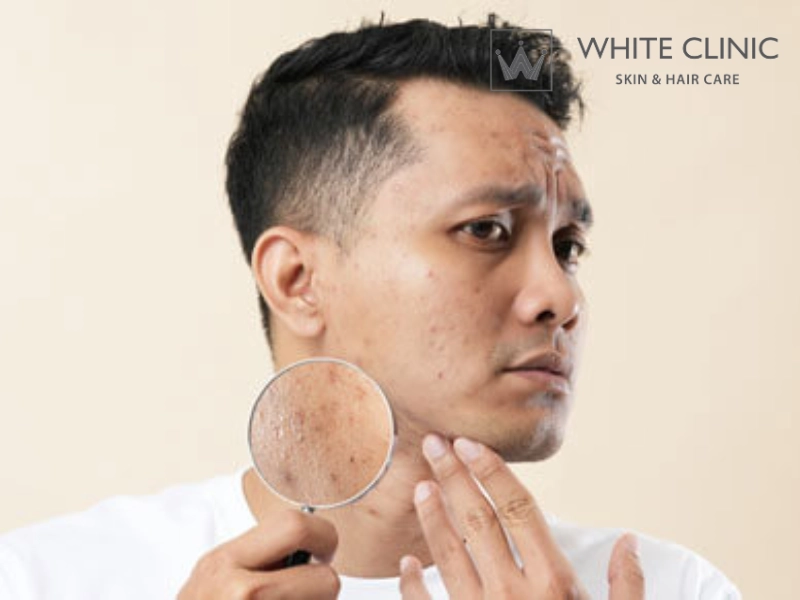 nguyên nhân bị nám da mặt ở nam giới