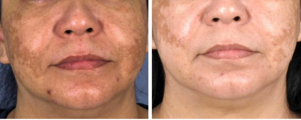 revlite-carbon-peel revlite-carbon-peel