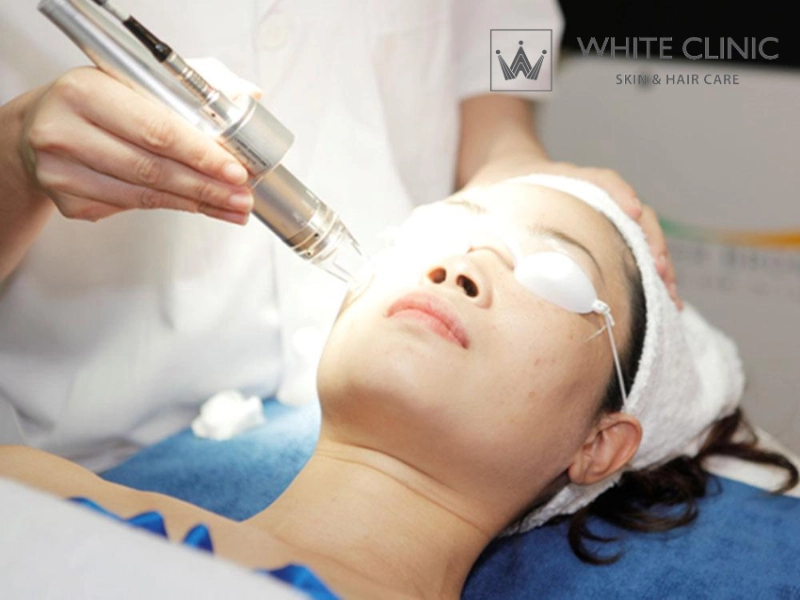 trị sẹo đáy nhọn trị sẹo đáy nhọn