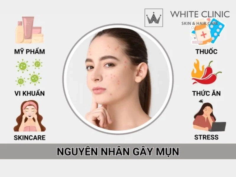 nguyên nhân gây mụn