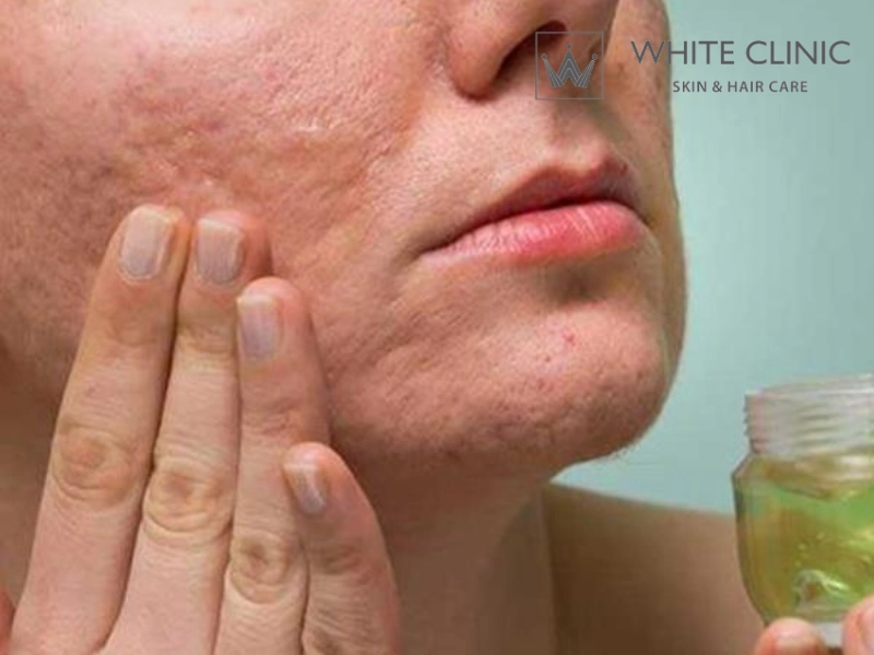 làm mờ sẹo bằng nha đam làm mờ sẹo bằng nha đam