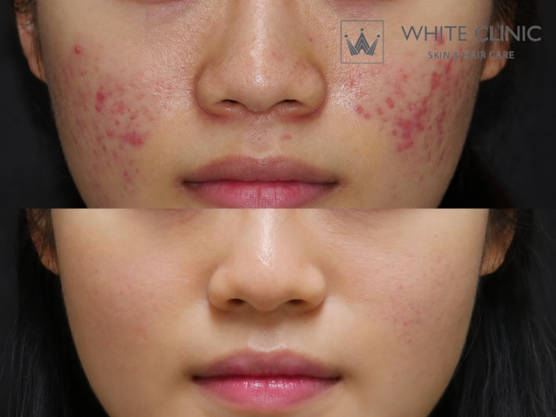 hết thâm mụn trong 1 tuần