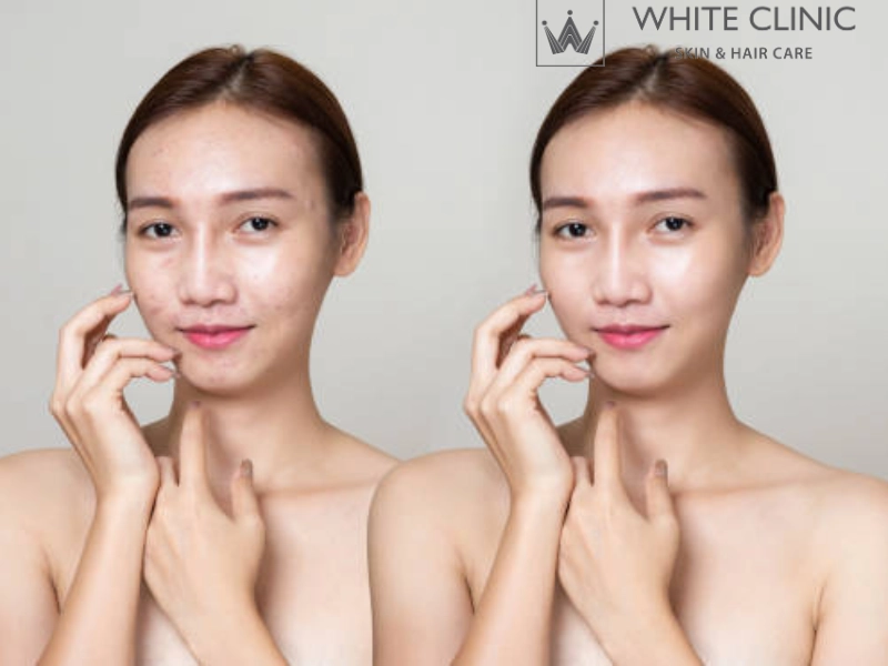 căng bóng da glossy skin