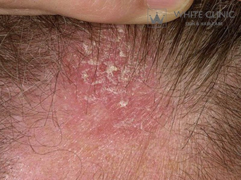 da đầu bị đỏ da đầu bị đỏ