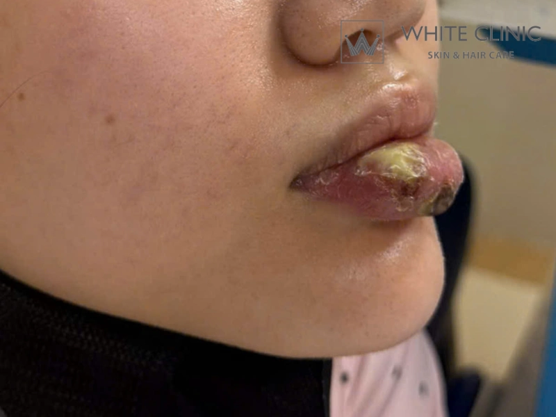 Biến Chứng Sau Tiêm Filler: Nhận Diện Dấu Hiệu Nguy Hiểm Và Thời Điểm Cần Can Thiệp Y Tế