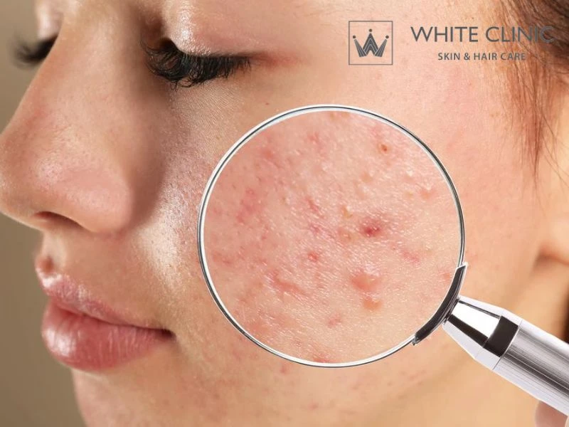 Cách Nhận Biết Các Loại Sẹo Mụn: Nguyên Nhân Hình Thành Và Phương Pháp Điều Trị 