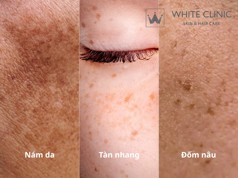 trị nám tàn nhang