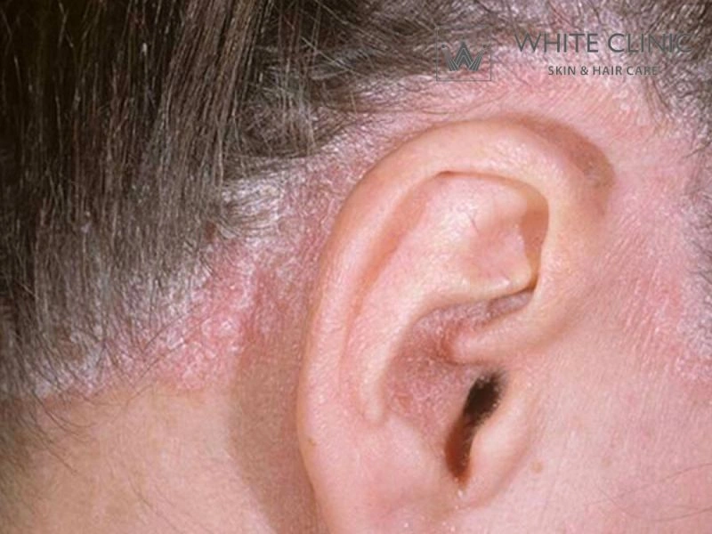 vảy nến da đầu