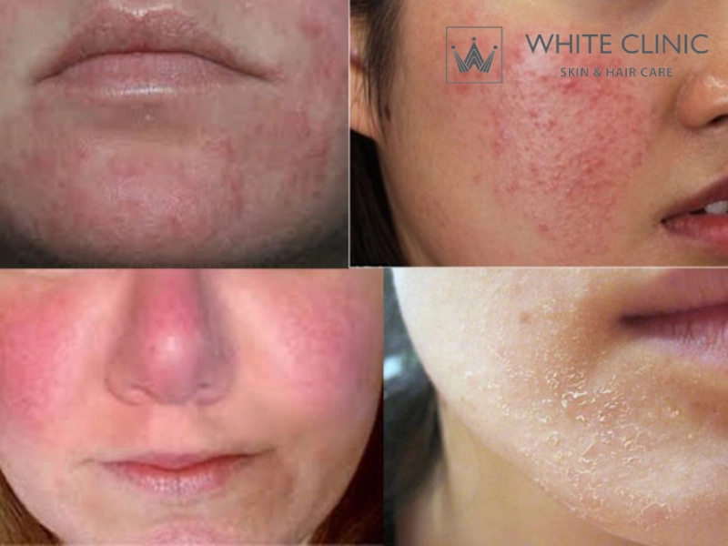 các vùng bị mụn trên mặt