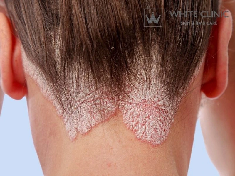 Bệnh Vảy Nến Da Đầu Là Gì? Nguyên Nhân Do Đâu Và Phương Pháp Điều Trị 