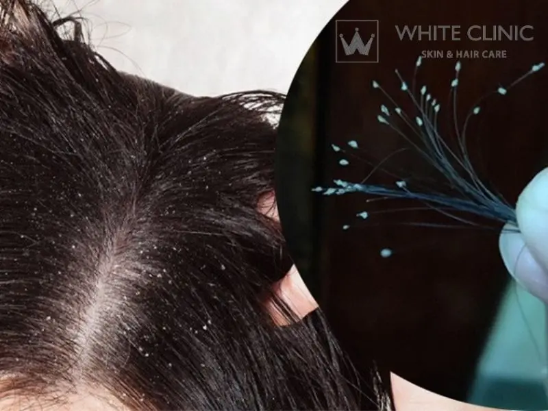 rụng tóc chân trắng