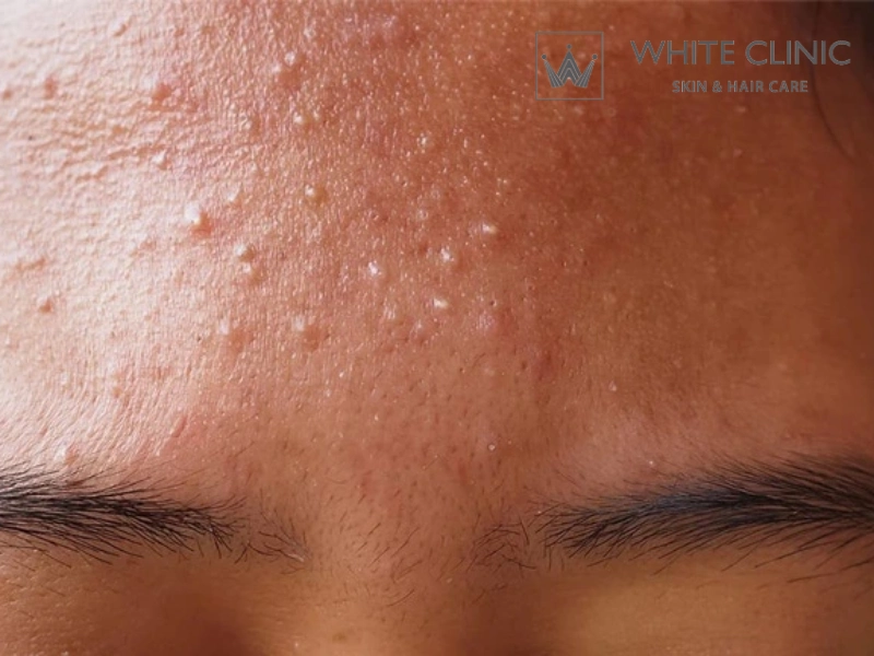 trị mụn ẩn cho da dầu