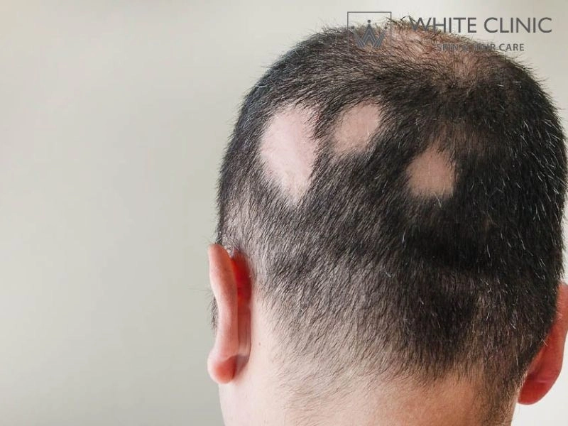 rụng tóc tự miễn