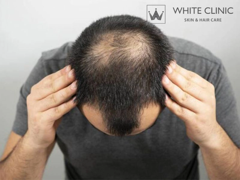 rụng tóc từng mảng