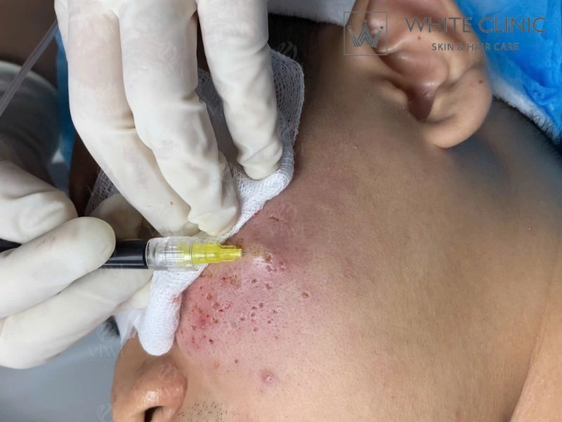 phương pháp trị sẹo rỗ phương pháp trị sẹo rỗ