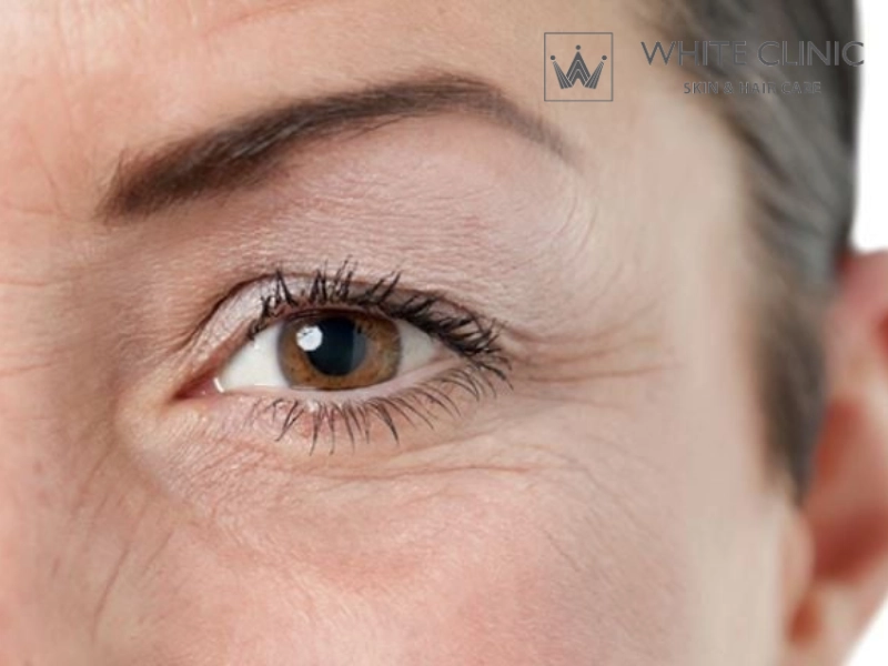 Nếp Nhăn Tĩnh Là Gì Và Giải Pháp Trẻ Hóa Bằng Bước Sóng Laser