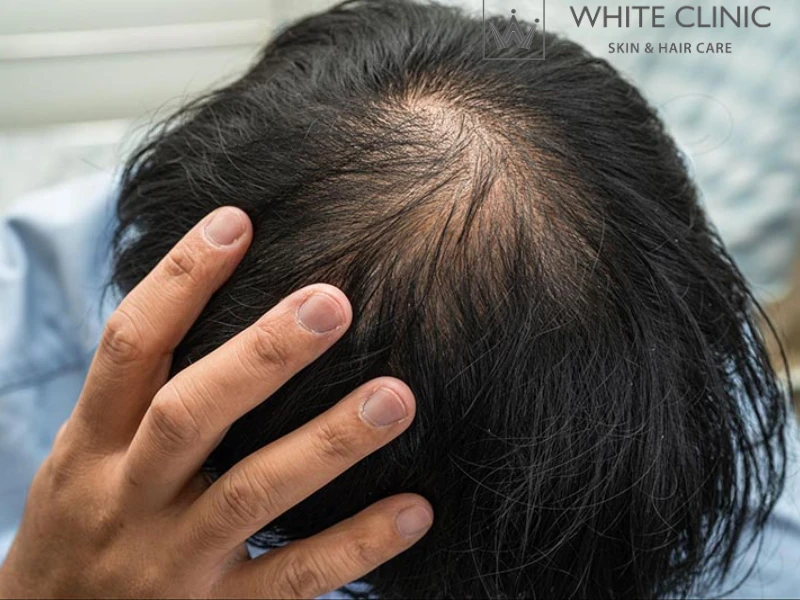 Nguyên Nhân Bị Hói Đỉnh Đầu Và Phương Pháp Điều Trị Hiệu Quả Tại White Clinic 