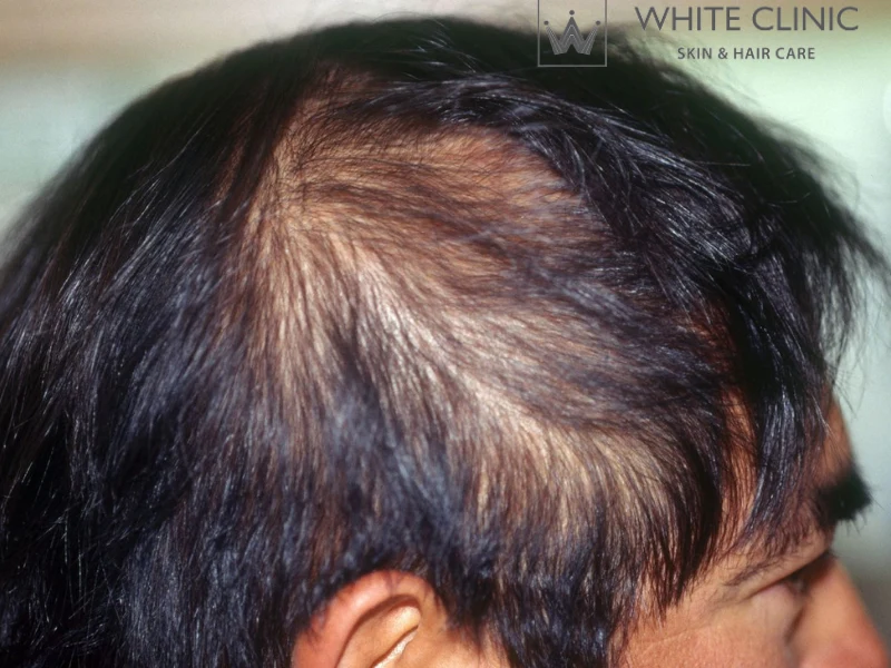 cách trị tóc thưa