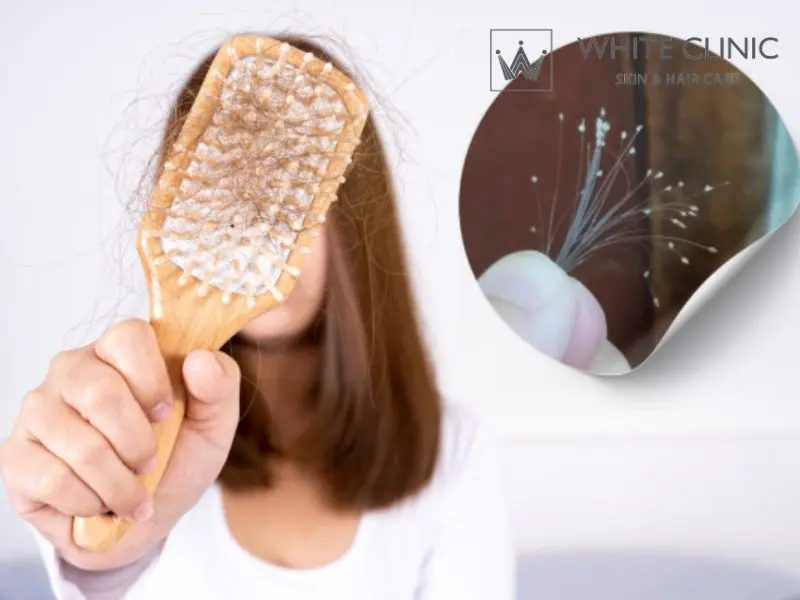 rụng tóc chân trắng