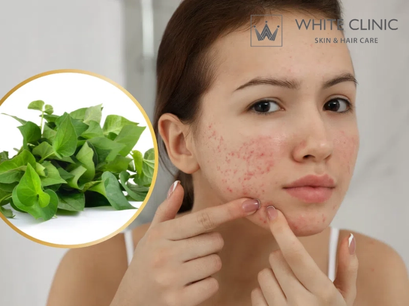 rau diếp cá trị mụn