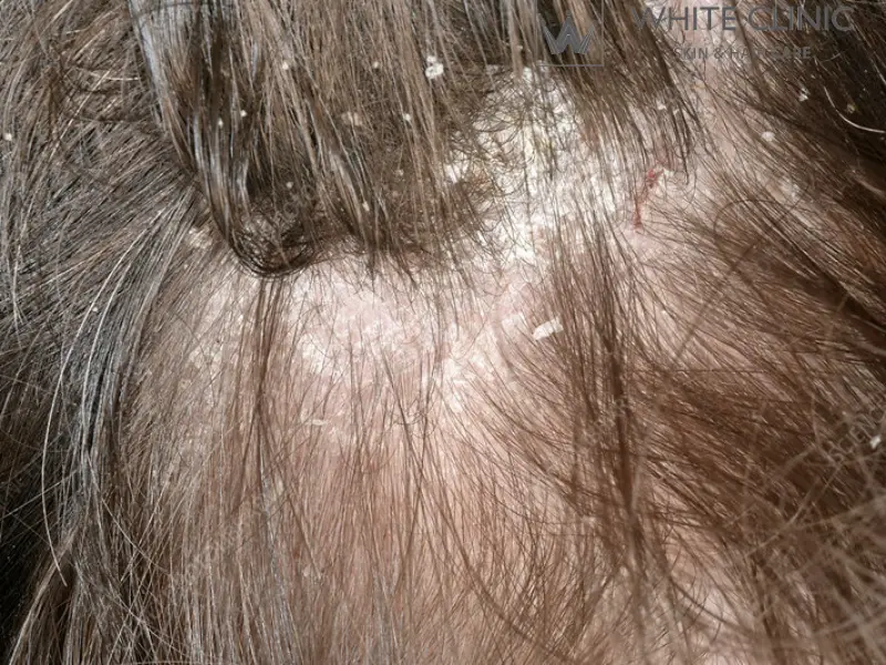 da đầu yếu da đầu yếu