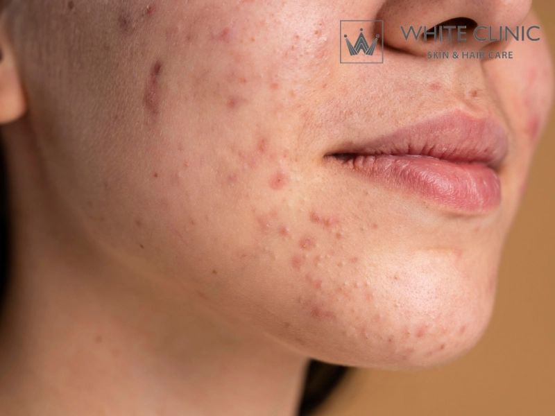 các vùng bị mụn trên mặt và nguyên nhân