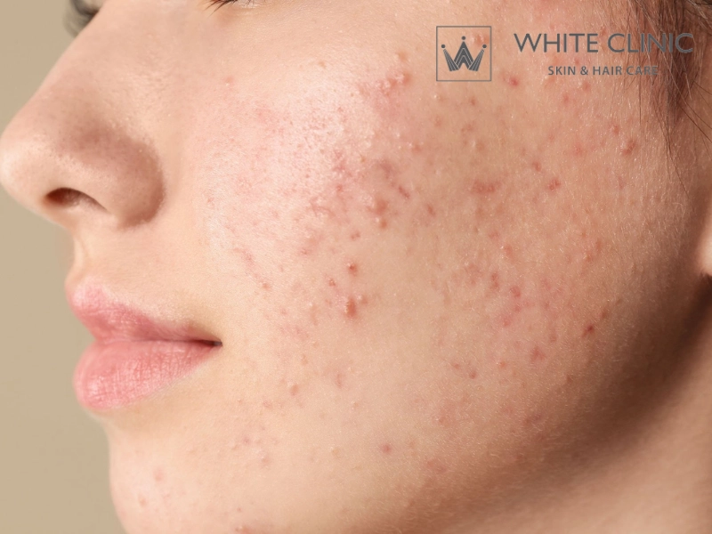 trị mụn bằng trà xanh