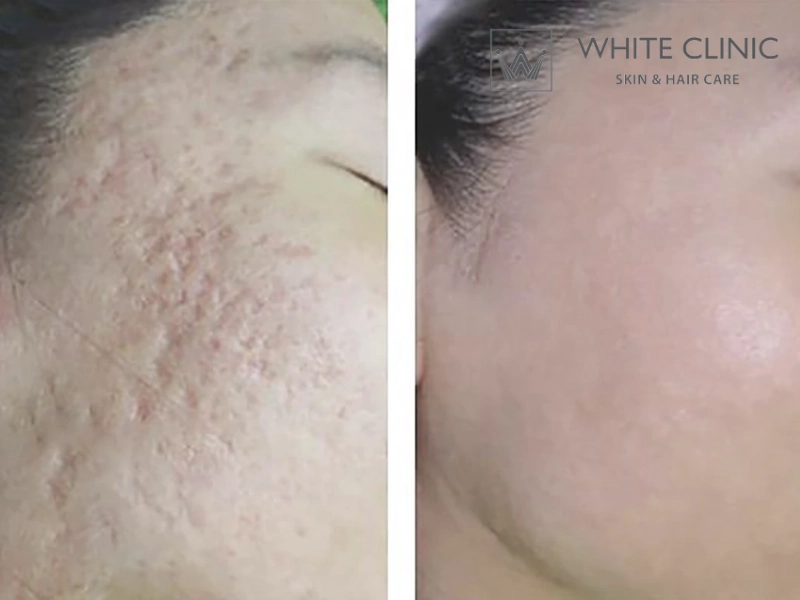 Quản lý rủi ro và kỳ vọng: Hành trình phục hồi sau điều trị sẹo lõm Quản lý rủi ro và kỳ vọng: Hành trình phục hồi sau điều trị sẹo lõm