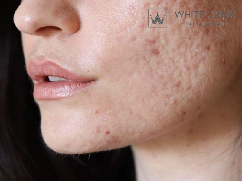 kim tách đáy sẹo kim tách đáy sẹo