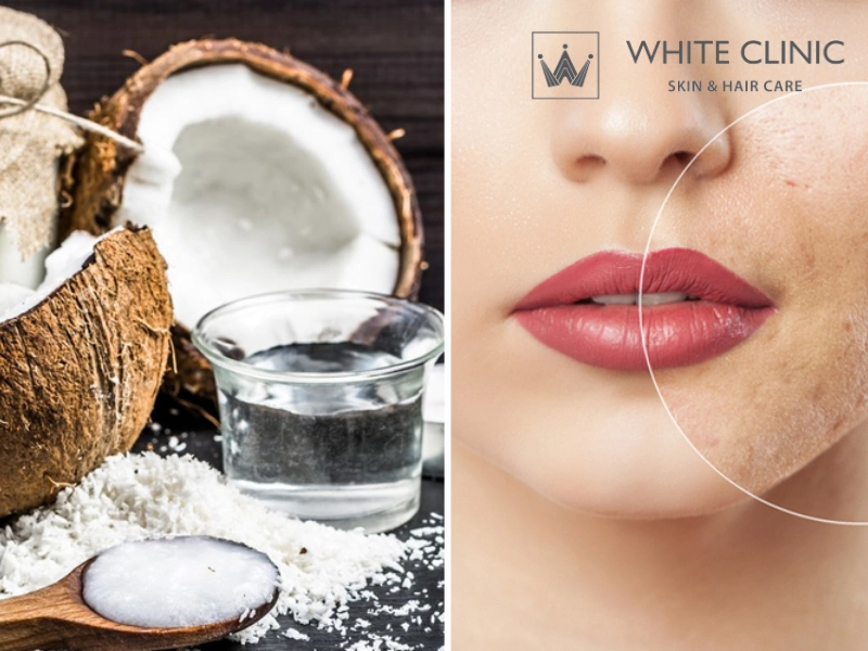 dầu dừa có trị mụn không