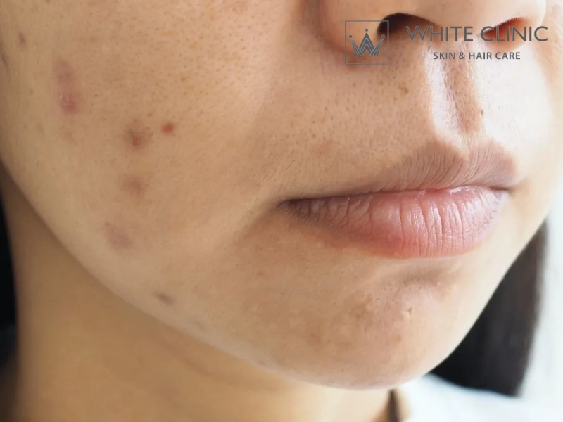 cách làm mặt nạ dưa leo trị thâm