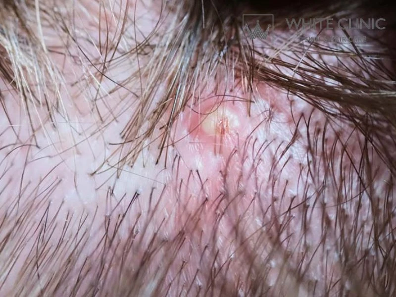 da đầu bị đỏ da đầu bị đỏ