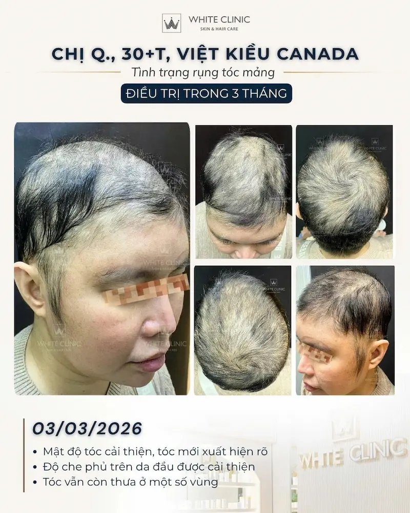 alopecia areata alopecia areata