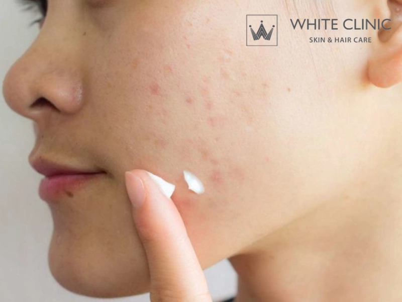 cách trị mụn thâm ở má