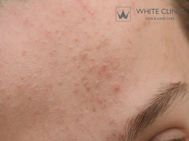 trị mụn cho da dầu