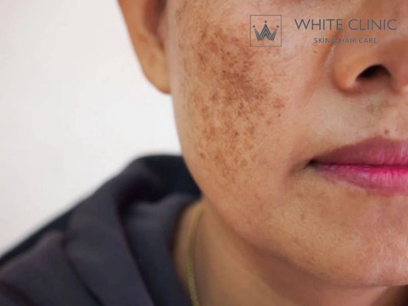 phân biệt nám và PIH phân biệt nám và PIH